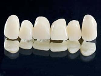 سفید کردن دندان فقط بر روی دندان‌های طبیعی قابل انجام است